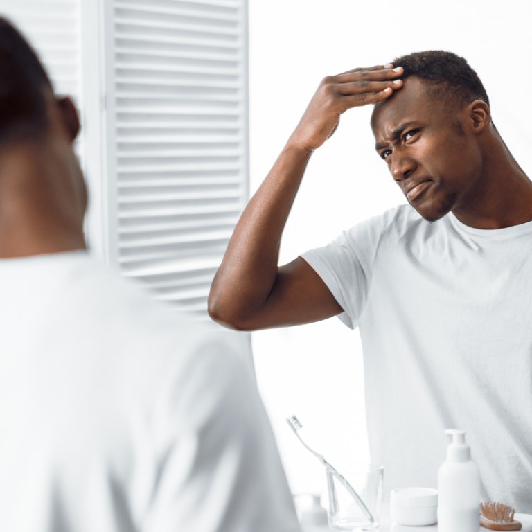 Reclaiming the Crown: Understanding and Addressing Hair Loss in the Black Community